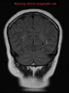 File:Neuroglial cyst (Radiopaedia 10713-11184 Coronal FLAIR 7).jpg