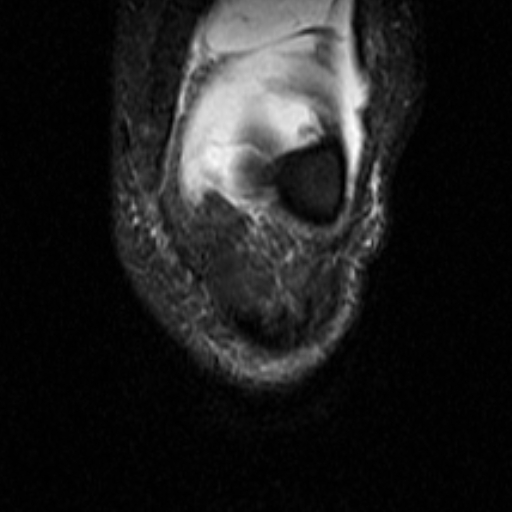 File:Non-displaced patella fracture (Radiopaedia 15932-15582 Coronal STIR 5).jpg