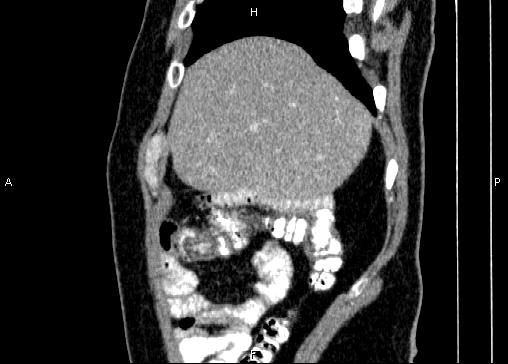 Non-syndromic pancreatic endocrine tumor (Radiopaedia 86958-103178 E 13).jpg