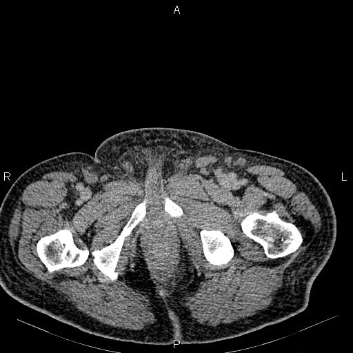 Non Hodgkin lymphoma in a patient with ankylosing spondylitis (Radiopaedia 84323-99621 Axial C+ delayed 89).jpg