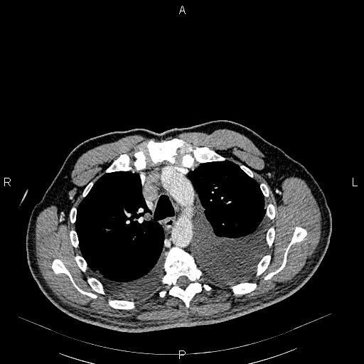 File:Non Hodgkin lymphoma in a patient with ankylosing spondylitis (Radiopaedia 84323-99621 B 12).jpg