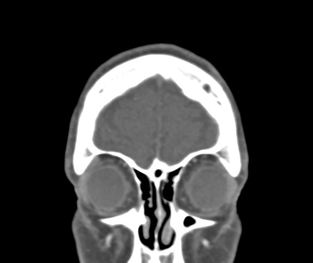 File:Normal CTA head (Radiopaedia 40801-43464 B 16).png