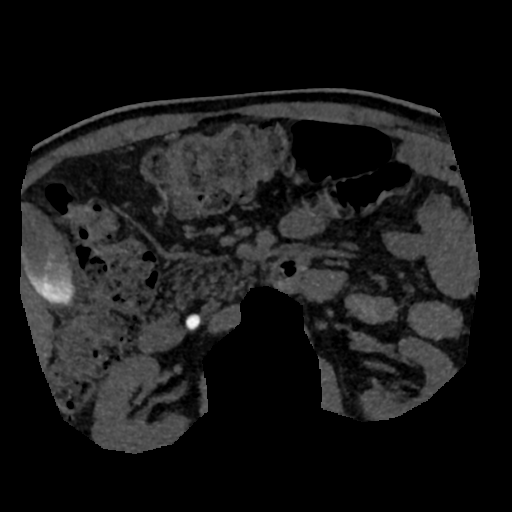 File:Normal CT intravenous cholangiogram (Radiopaedia 38199-40208 Axial IVC (MIP) 15).png