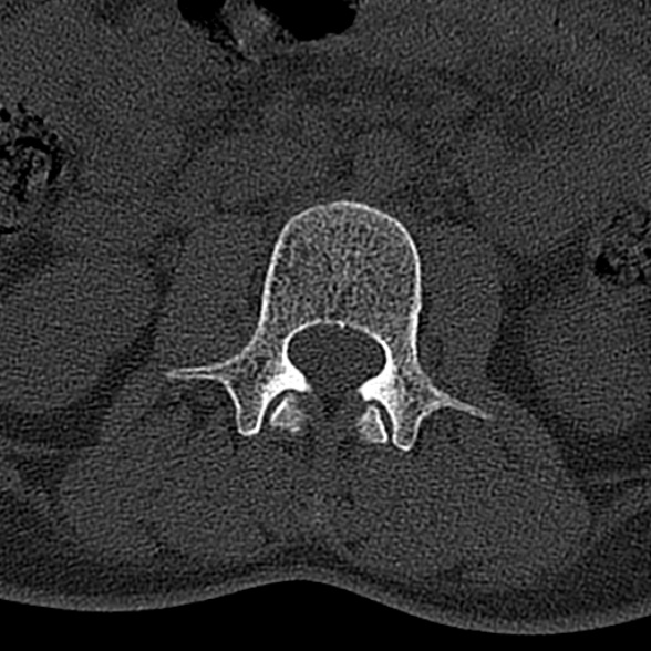 File:Normal CT lumbar spine (Radiopaedia 53981-60118 Axial bone window 33).jpg