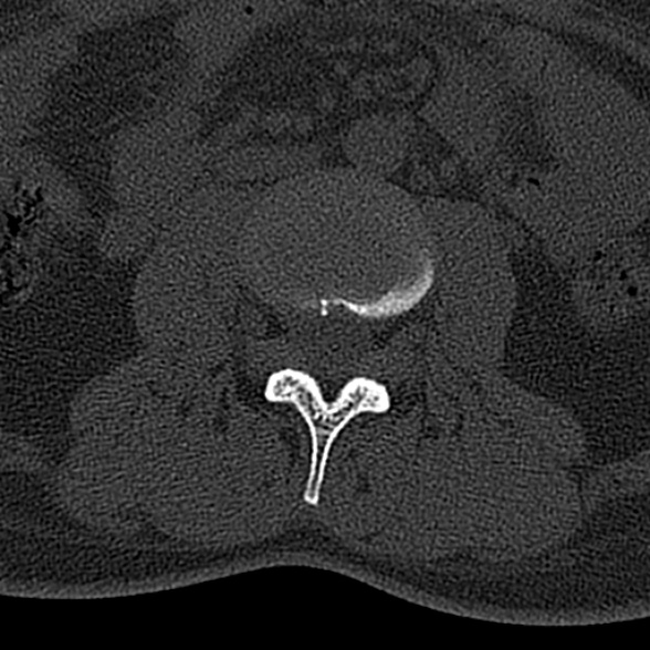 File:Normal CT lumbar spine (Radiopaedia 53981-60118 Axial bone window 39).jpg