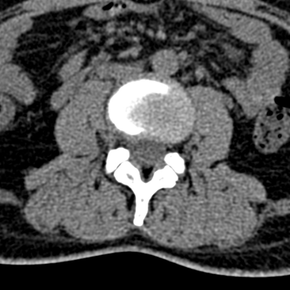 Normal CT lumbar spine (Radiopaedia 53981-60118 Axial non-contrast 56).jpg