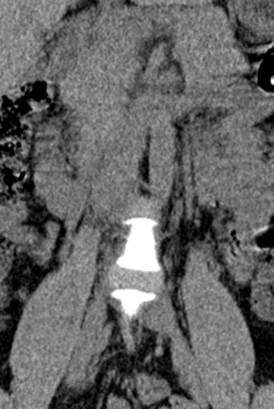 Normal CT lumbar spine (Radiopaedia 53981-60118 F 4).jpg