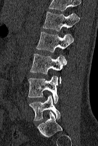 File:Normal CT lumbar spine (Radiopaedia 53981-60118 Sagittal bone window 63).jpg