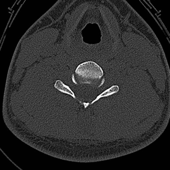 Normal CT of the cervical spine (Radiopaedia 53322-59305 Axial bone window 168).jpg