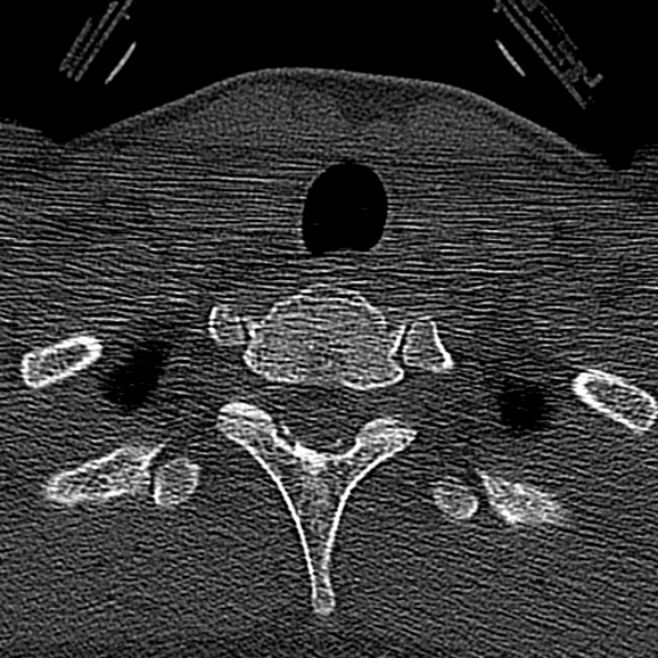 File:Normal CT of the cervical spine (Radiopaedia 53322-59305 Axial bone window 240).jpg