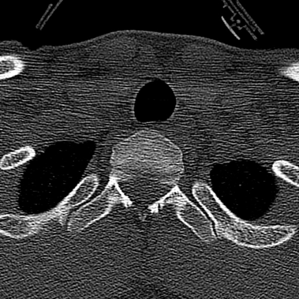 Normal CT of the cervical spine (Radiopaedia 53322-59305 Axial bone window 249).jpg