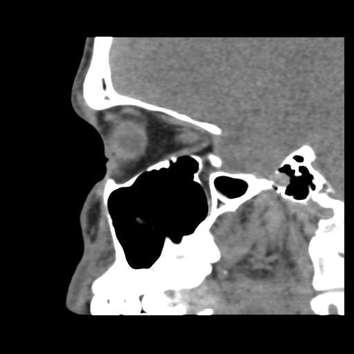 Normal CT paranasal sinuses (Radiopaedia 42286-45390 F 97).jpg
