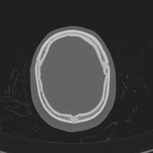 Normal CT skull (Radiopaedia 40798-43459 A 135).png