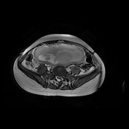File:Normal MRI abdomen in pregnancy (Radiopaedia 88001-104541 Axial Gradient Echo 37).jpg