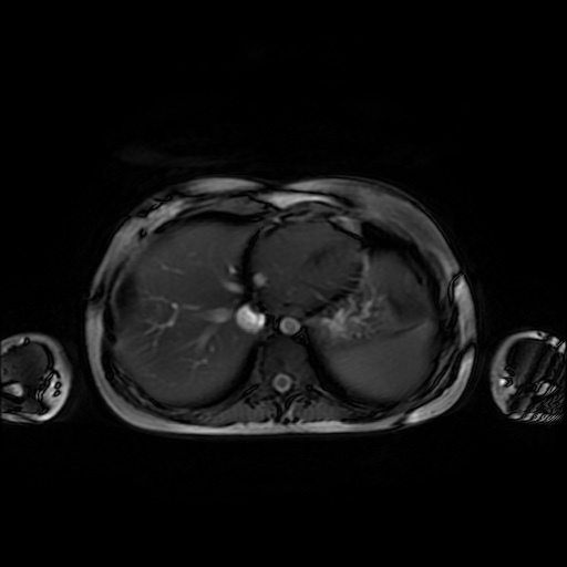 File:Normal MRI abdomen in pregnancy (Radiopaedia 88001-104541 Axial Gradient Echo 6).jpg