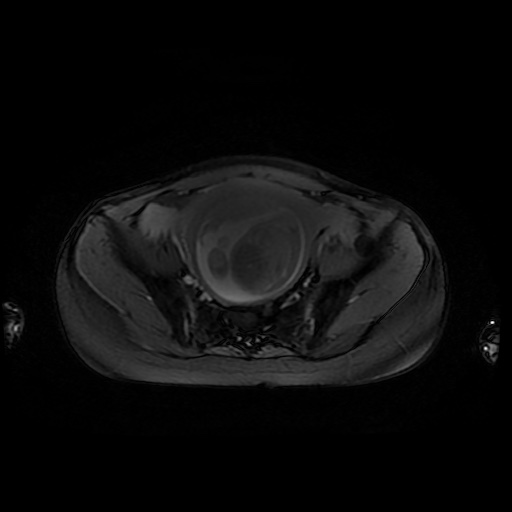 File:Normal MRI abdomen in pregnancy (Radiopaedia 88001-104541 D 44).jpg