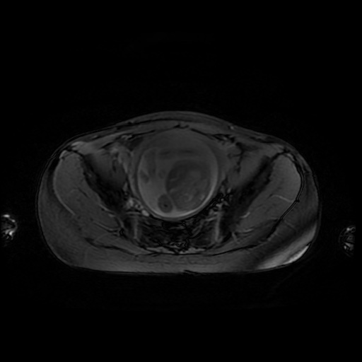 File:Normal MRI abdomen in pregnancy (Radiopaedia 88001-104541 D 46).jpg
