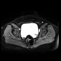 Normal MRI abdomen in pregnancy (Radiopaedia 88005-104548 Axial DWI 15).jpg