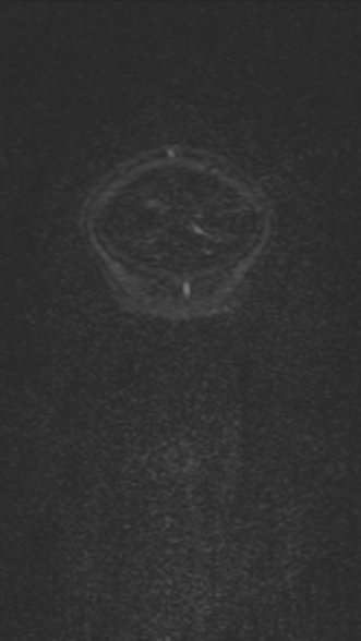 Normal MRI brain with MRV- teenager (Radiopaedia 49425-54553 Coronal MRV 35).jpg