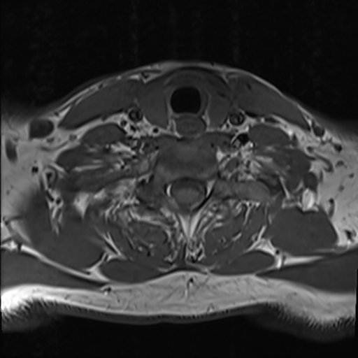 File:Normal MRI cervical spine (infection protocol) (Radiopaedia 53916-60039 Axial 40).png