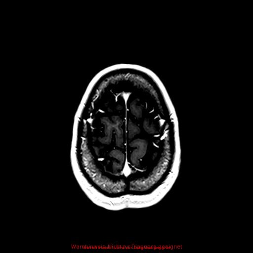 Normal adult brain MRI (non-enhanced and contrast-enhanced) (Radiopaedia 75262-86379 Axial T1 C+ 161).jpg