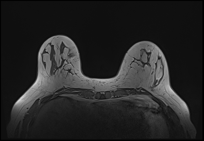 File:Normal breast MRI - dense breasts (Radiopaedia 80454-93850 Axial T1 65).jpg