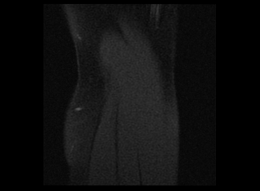 File:Normal elbow arthrograms (Radiopaedia 75550-86805 Sagittal T1 fat sat 2).jpg