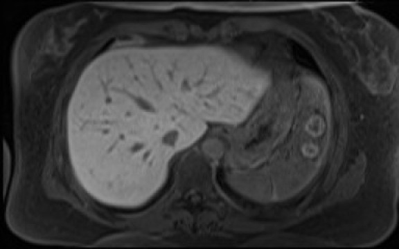 File:Normal hepatobiliary phase liver MRI (Radiopaedia 58968-66230 A 24).jpg