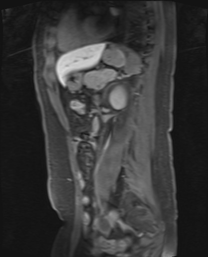 File:Normal hepatobiliary phase liver MRI (Radiopaedia 58968-66230 C 51).jpg