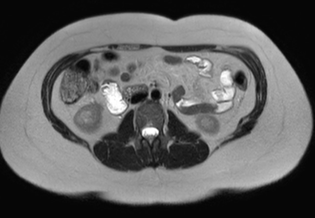 File:Normal liver MRI with Gadolinium (Radiopaedia 58913-66163 Axial T2 7).jpg