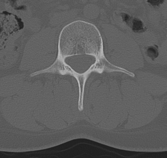 File:Normal lumbar spine CT (Radiopaedia 46533-50986 Axial bone window 36).png