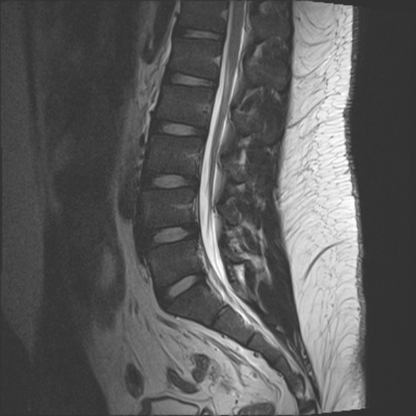 File:Normal lumbar spine MRI (Radiopaedia 47857-52609 Sagittal T2 11).jpg