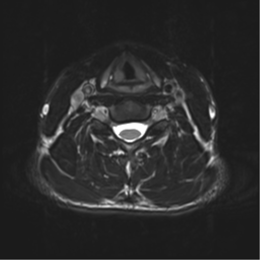 Normal trauma cervical spine (Radiopaedia 41017-43762 D 32).png
