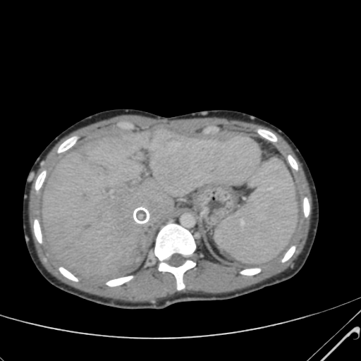 File:Nutmeg liver- Budd-Chiari syndrome (Radiopaedia 46234-50635 B 14).png