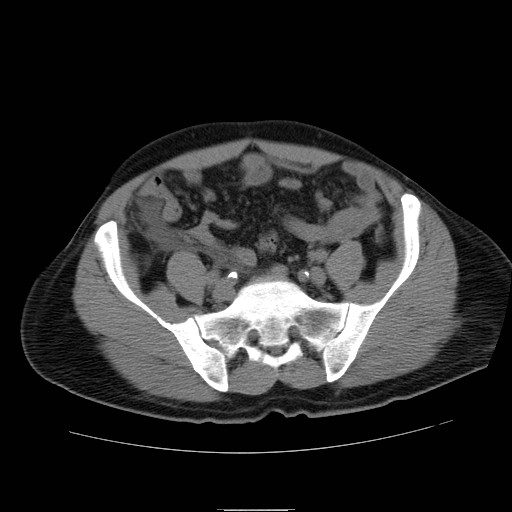 File:Obstructed kidney with perinephric urinoma (Radiopaedia 26889-27066 Axial non-contrast 49).jpg