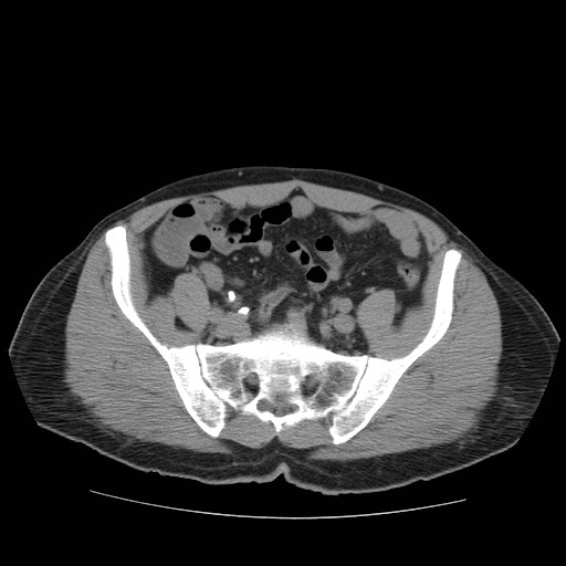 File:Obstructed kidney with perinephric urinoma (Radiopaedia 26889-27067 Axial non-contrast 35).jpg