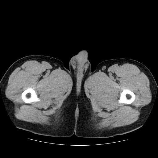 File:Obstructing ureteric calculus (Radiopaedia 18615-18514 Axial non-contrast 64).jpg