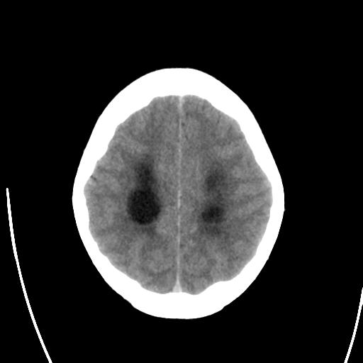 File:Obstructive hydrocephalus (Radiopaedia 30453-31119 Axial non-contrast 22).jpg
