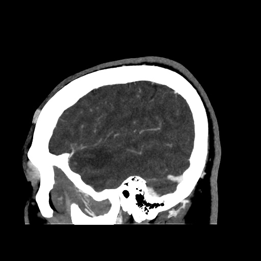 Occipital extradural hematoma simulating venous sinus thrombosis (Radiopaedia 46514-50964 D 63).jpg