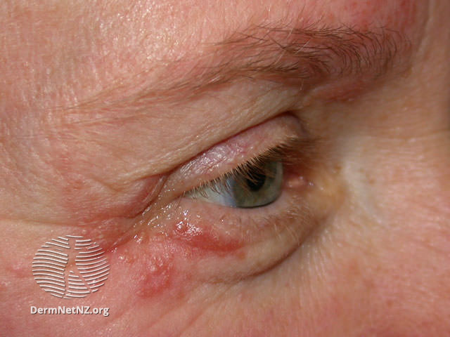 File:Periocular dermatitis (DermNet NZ acne-pod4).jpg