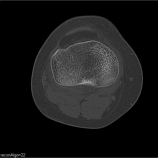 File:ACL avulsion fracture (Radiopaedia 33833-34994 Axial bone window 19).jpg