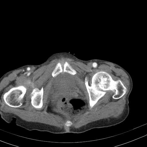 File:Abdominal aortic aneurysm (Radiopaedia 20827-20742 Axial C+ arterial phase 40).jpg