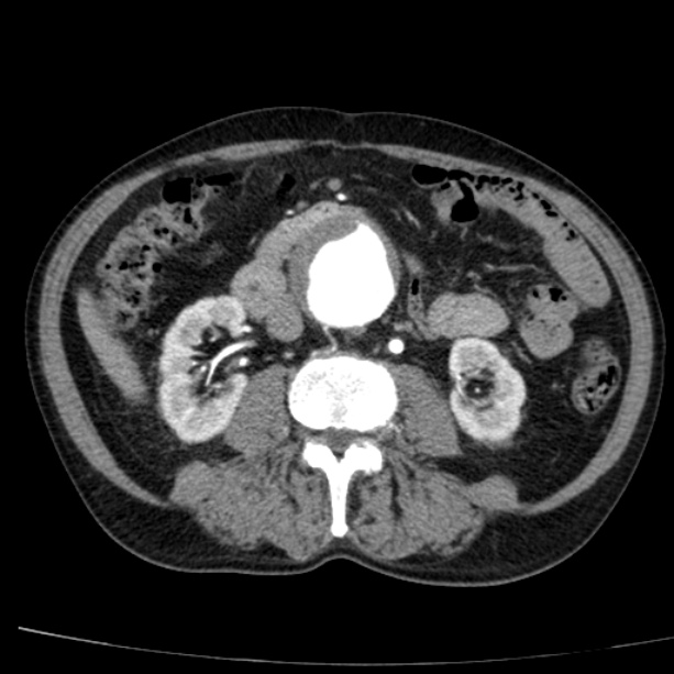 Abdominal aortic aneurysm (Radiopaedia 29248-29660 Axial C+ arterial phase 42).jpg