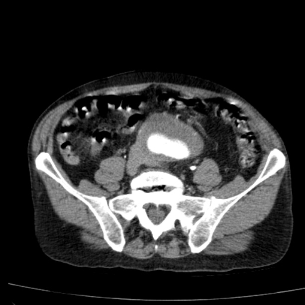 Abdominal aortic aneurysm (Radiopaedia 29248-29660 Axial C+ arterial phase 61).jpg