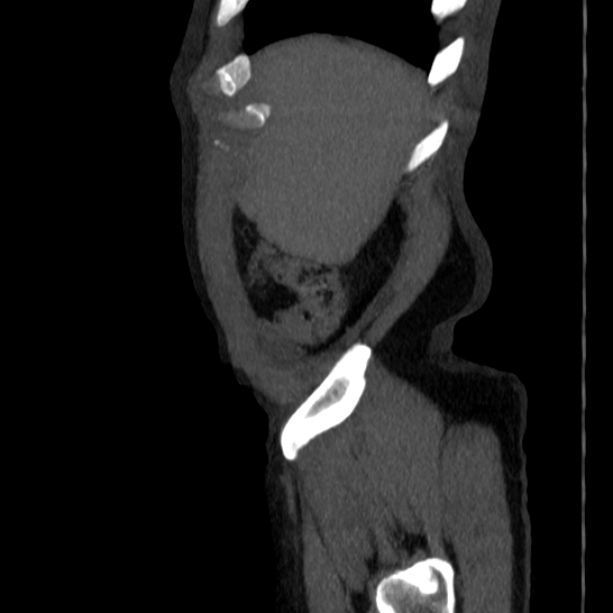 Abdominal aortic aneurysm (Radiopaedia 29248-29660 Sagittal C+ arterial phase 3).jpg