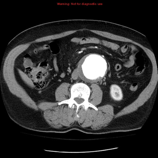 File:Abdominal aortic aneurysm (Radiopaedia 8190-9038 Axial C+ arterial phase 42).jpg