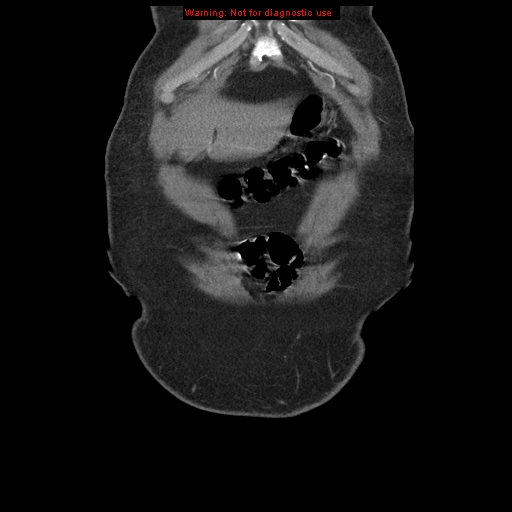 File:Abdominal aortic aneurysm (Radiopaedia 8190-9038 Coronal C+ arterial phase 12).jpg