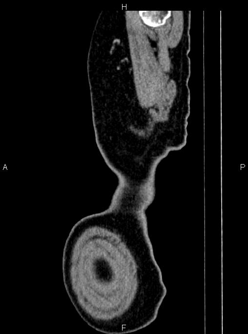 Abdominal aortic aneurysm (Radiopaedia 83094-97462 Sagittal renal cortical phase 4).jpg