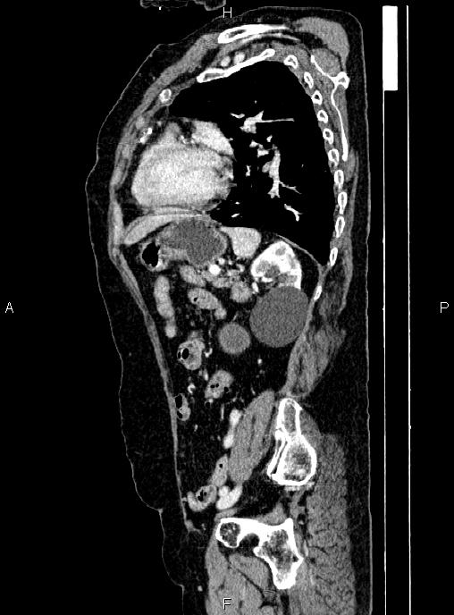 Abdominal aortic aneurysm (Radiopaedia 85063-100606 Sagittal C+ arterial phase 59).jpg