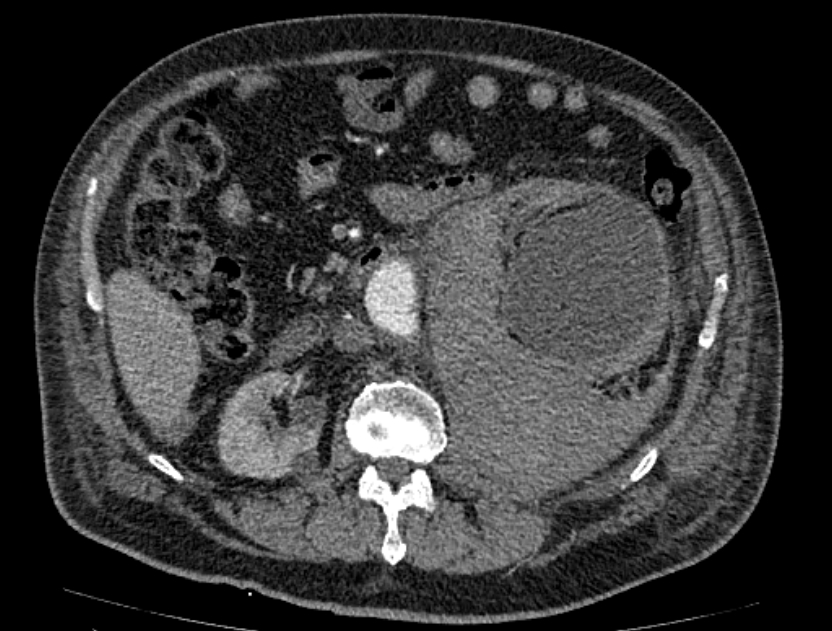 Abdominal aortic aneurysm rupture (Radiopaedia 54179-60362 Axial C+ arterial phase 31).jpg